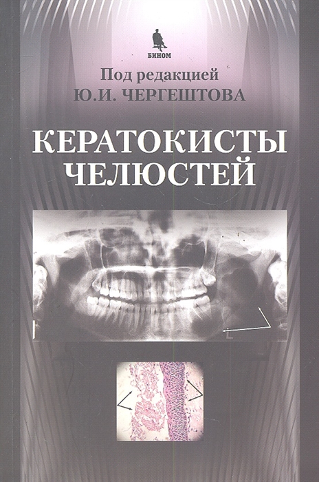 

Кератокисты челюстей