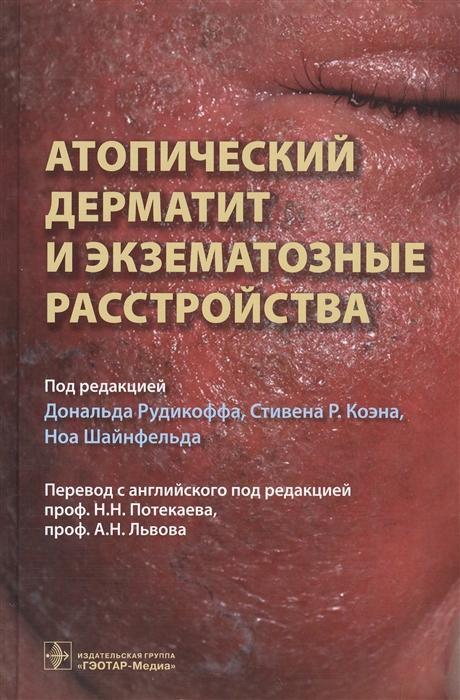 

Атопический дерматит и экзематорные расстройства