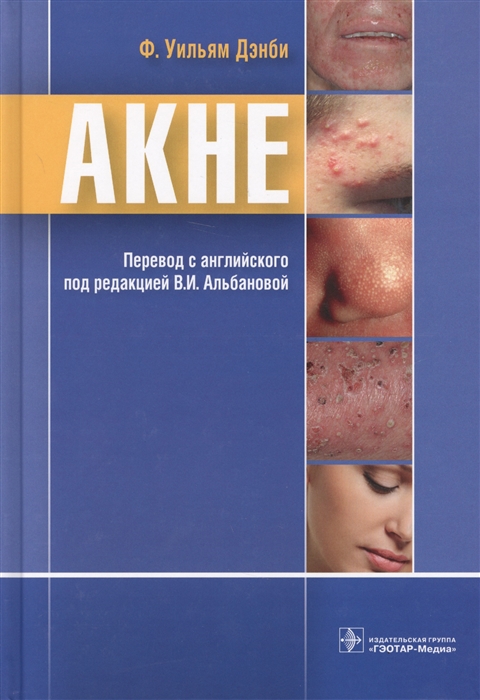 

Акне