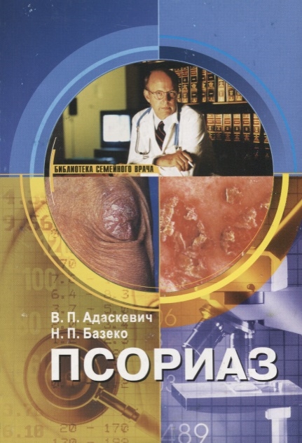 

Псориаз