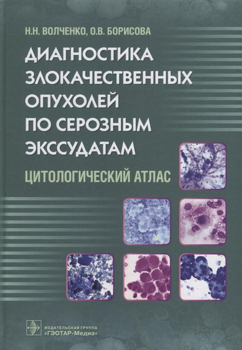 Волченко Н., Борисова О. - Диагностика злокачественных опухолей по серозным экссудатам