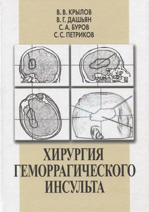 Хирургия геморрагического инсульта