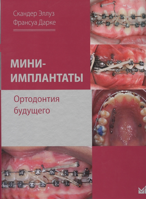 

Мини-имплантаты Ортодонтия будущего
