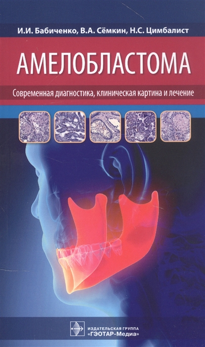 

Амелобластома современная диагностика клиническая картина и лечение