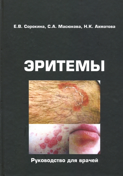 

Эритемы Руководство для врачей