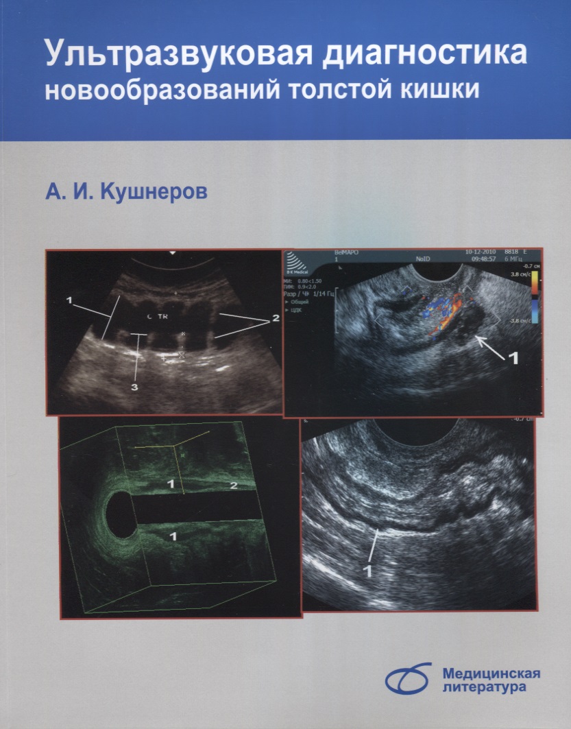 Кушнеров А. Ультразвуковая диагностика новообразований толстой кишки